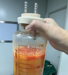 玉环水动力吸脂手术要做多久？